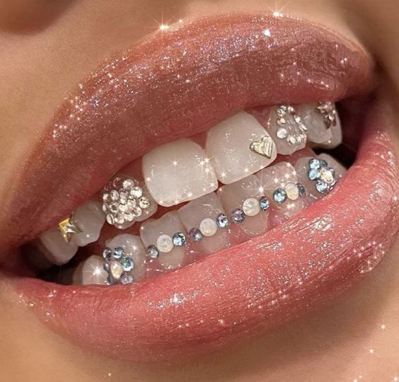 Le strass dentaire : La tendance des années 00's fait son grand retour
